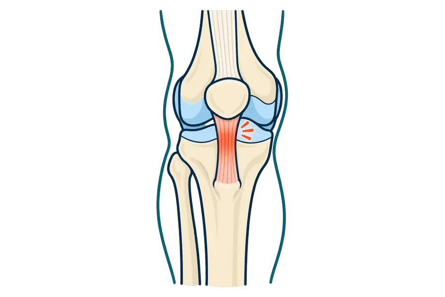 Inflamed tendon below the kneecap